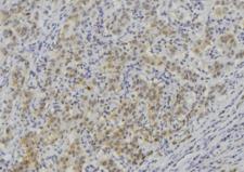 LAMC3 / Laminin Gamma 3 Antibody - 1:100 staining human lung carcinoma tissue by IHC-P. The sample was formaldehyde fixed and a heat mediated antigen retrieval step in citrate buffer was performed. The sample was then blocked and incubated with the antibody for 1.5 hours at 22°C. An HRP conjugated goat anti-rabbit antibody was used as the secondary.