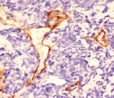 Laminin Antibody - IHC-P: Laminin antibody testing of human lung cancer tissue