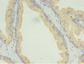 LAMP2 / CD107b Antibody - Immunohistochemistry of paraffin-embedded human prostate cancer using antibody at 1:100 dilution.  This image was taken for the unconjugated form of this product. Other forms have not been tested.