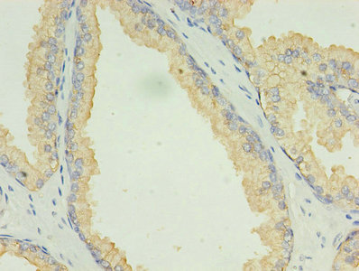 LAMP2 / CD107b Antibody - Immunohistochemistry of paraffin-embedded human prostate cancer using LAMP2 Antibody at dilution of 1:100