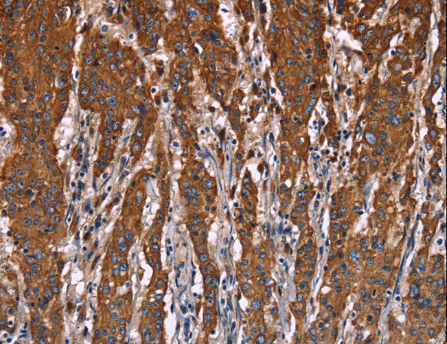 LAMP2 / CD107b Antibody - Immunohistochemistry of paraffin-embedded Human gastric cancer using LAMP2 Polyclonal Antibody at dilution of 1:40.
