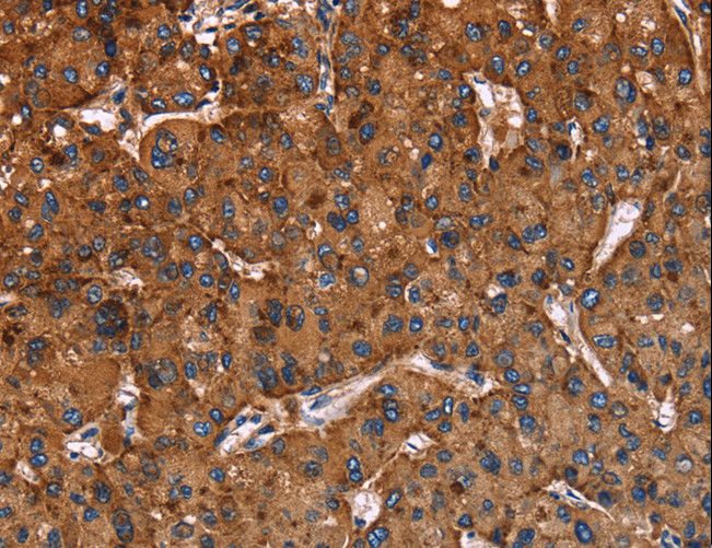 LAMP2 / CD107b Antibody - Immunohistochemistry of paraffin-embedded Human liver cancer using LAMP2 Polyclonal Antibody at dilution of 1:40.