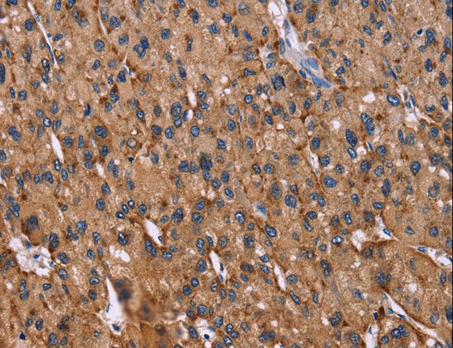 LAMP2 / CD107b Antibody - Immunohistochemistry of paraffin-embedded Human thyroid cancer using LAMP2 Polyclonal Antibody at dilution of 1:30.