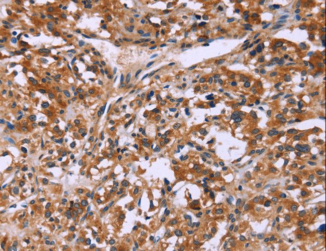 LAMP2 / CD107b Antibody - Immunohistochemistry of paraffin-embedded Human thyroid cancer using LAMP2 Polyclonal Antibody at dilution of 1:30.