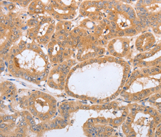 LAMP3 / CD208 Antibody - Immunohistochemistry of paraffin-embedded human thyroid cancer tissue.