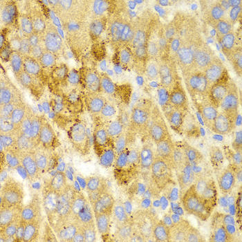 LAMP3 / CD208 Antibody - Immunohistochemistry of paraffin-embedded liver cancer tissue.