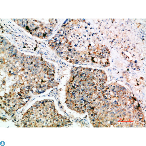 LAMP3 / CD208 Antibody - Immunohistochemical analysis of paraffin-embedded human-lung-cancer, antibody was diluted at 1:200.