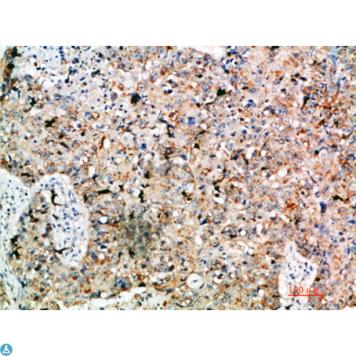 LAMP3 / CD208 Antibody - Immunohistochemical analysis of paraffin-embedded human-lung-cancer, antibody was diluted at 1:200.