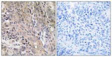 LAMP3 / CD208 Antibody - Peptide - + Immunohistochemistry analysis of paraffin-embedded human lung carcinoma tissue using LAMP3 antibody.
