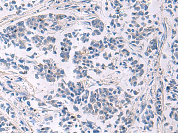 LAMP3 / CD208 Antibody - Immunohistochemistry of paraffin-embedded Human breast cancer tissue  using LAMP3 Polyclonal Antibody at dilution of 1:30(×200)