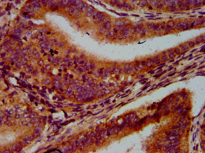 LAMTOR1 Antibody - Immunohistochemistry Dilution at 1:600 and staining in paraffin-embedded human endometrial cancer performed on a Leica BondTM system. After dewaxing and hydration, antigen retrieval was mediated by high pressure in a citrate buffer (pH 6.0). Section was blocked with 10% normal Goat serum 30min at RT. Then primary antibody (1% BSA) was incubated at 4°C overnight. The primary is detected by a biotinylated Secondary antibody and visualized using an HRP conjugated SP system.