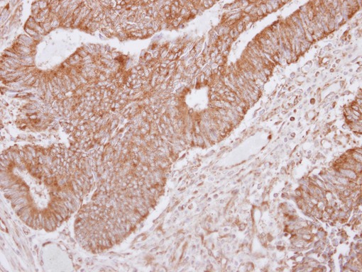 LANO / LRRC1 Antibody - IHC of paraffin-embedded Breast ca, using LRRC1 antibody at 1:250 dilution.