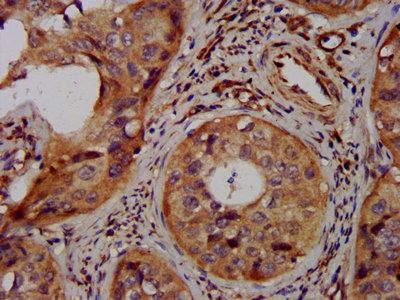LAPTM4A Antibody - Immunohistochemistry image at a dilution of 1:300 and staining in paraffin-embedded human cervical cancer performed on a Leica BondTM system. After dewaxing and hydration, antigen retrieval was mediated by high pressure in a citrate buffer (pH 6.0) . Section was blocked with 10% normal goat serum 30min at RT. Then primary antibody (1% BSA) was incubated at 4 °C overnight. The primary is detected by a biotinylated secondary antibody and visualized using an HRP conjugated SP system.