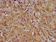 LAPTM4B Antibody - Immunohistochemistry image at a dilution of 1:600 and staining in paraffin-embedded human liver cancer performed on a Leica BondTM system. After dewaxing and hydration, antigen retrieval was mediated by high pressure in a citrate buffer (pH 6.0) . Section was blocked with 10% normal goat serum 30min at RT. Then primary antibody (1% BSA) was incubated at 4 °C overnight. The primary is detected by a biotinylated secondary antibody and visualized using an HRP conjugated SP system.