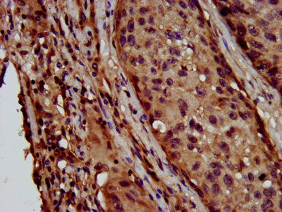 LAPTM4B Antibody - Immunohistochemistry image at a dilution of 1:600 and staining in paraffin-embedded human lung cancer performed on a Leica BondTM system. After dewaxing and hydration, antigen retrieval was mediated by high pressure in a citrate buffer (pH 6.0) . Section was blocked with 10% normal goat serum 30min at RT. Then primary antibody (1% BSA) was incubated at 4 °C overnight. The primary is detected by a biotinylated secondary antibody and visualized using an HRP conjugated SP system.