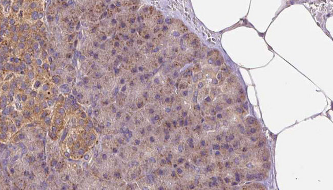 LAPTM4B Antibody - 1:100 staining human pancreas carcinoma tissue by IHC-P. The sample was formaldehyde fixed and a heat mediated antigen retrieval step in citrate buffer was performed. The sample was then blocked and incubated with the antibody for 1.5 hours at 22°C. An HRP conjugated goat anti-rabbit antibody was used as the secondary.
