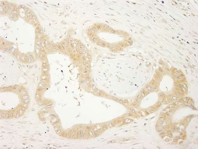 LARP1 / La-Related Protein 1 Antibody - Detection of Human LARP1 by Immunohistochemistry. Sample: FFPE section of human colon carcinoma. Antibody: Affinity purified rabbit anti-LARP1 used at a dilution of 1:200 (1 Detection: DAB.