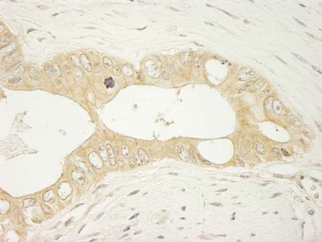 LARP1 / La-Related Protein 1 Antibody - Detection of Human LARP1 by Immunohistochemistry. Sample: FFPE section of human colon carcinoma. Antibody: Affinity purified rabbit anti-LARP used at a dilution of 1:250.