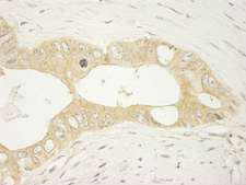 LARP1 / La-Related Protein 1 Antibody - Detection of Human LARP1 by Immunohistochemistry. Sample: FFPE section of human colon carcinoma. Antibody: Affinity purified rabbit anti-LARP used at a dilution of 1:250.