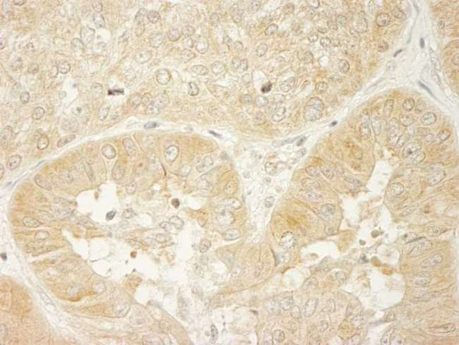 LARP1 / La-Related Protein 1 Antibody - Detection of Human LARP1 by Immunohistochemistry. Sample: FFPE section of human ovarian carcinoma. Antibody: Affinity purified rabbit anti-LARP1 used at a dilution of 1:200 (1 Detection: DAB.