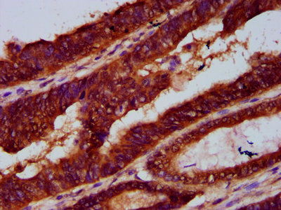 LARP7 Antibody - Immunohistochemistry Dilution at 1:300 and staining in paraffin-embedded human colon cancer performed on a Leica BondTM system. After dewaxing and hydration, antigen retrieval was mediated by high pressure in a citrate buffer (pH 6.0). Section was blocked with 10% normal Goat serum 30min at RT. Then primary antibody (1% BSA) was incubated at 4°C overnight. The primary is detected by a biotinylated Secondary antibody and visualized using an HRP conjugated SP system.