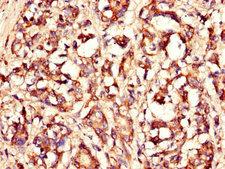 LASP1 Antibody - Immunohistochemistry of paraffin-embedded human gastric cancer using LASP1 Antibody at dilution of 1:100