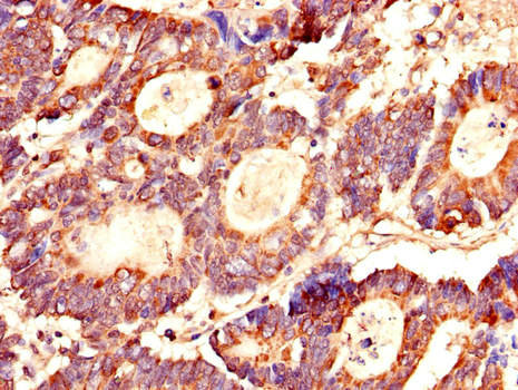 LASP1 Antibody - Immunohistochemistry of paraffin-embedded human colon cancer using LASP1 Antibody at dilution of 1:100