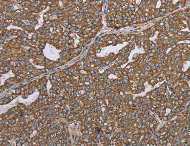 LASS4 Antibody - Immunohistochemistry of paraffin-embedded Human ovarian cancer using CERS4 Polyclonal Antibody at dilution of 1:35.