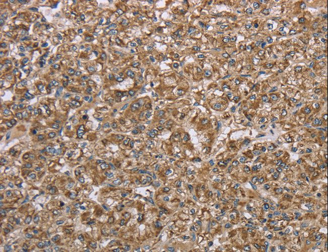 LASS4 Antibody - Immunohistochemistry of paraffin-embedded Human prostate cancer using CERS4 Polyclonal Antibody at dilution of 1:35.
