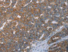 LASS4 Antibody - Immunohistochemistry of paraffin-embedded Human colon cancer using CERS4 Polyclonal Antibody at dilution of 1:35.