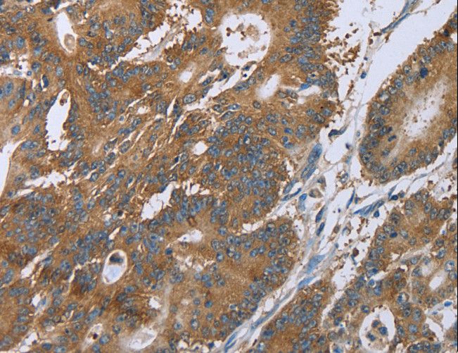 LASS4 Antibody - Immunohistochemistry of paraffin-embedded Human colon cancer using CERS4 Polyclonal Antibody at dilution of 1:35.