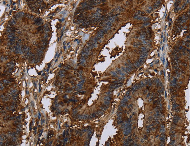 LASS5 Antibody - Immunohistochemistry of paraffin-embedded Human colon cancer using CERS5 Polyclonal Antibody at dilution of 1:40.