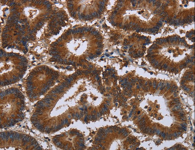 LASS5 Antibody - Immunohistochemistry of paraffin-embedded Human colon cancer using CERS5 Polyclonal Antibody at dilution of 1:35.