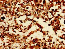 LASS5 Antibody - Immunohistochemistry image of paraffin-embedded human melanoma cancer at a dilution of 1:100