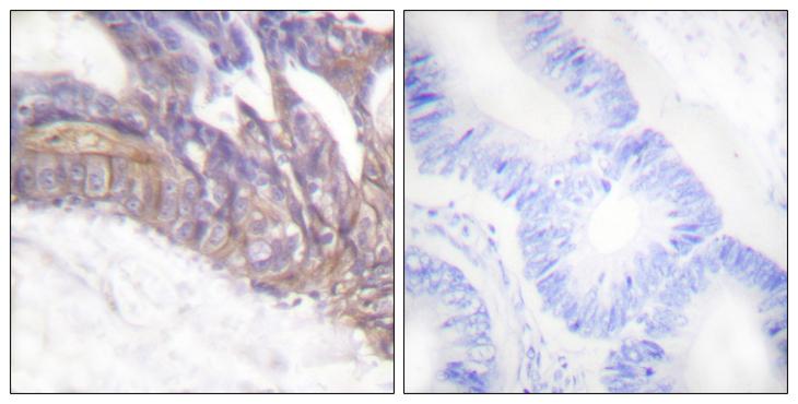 LAT Antibody - P-peptide - + Immunohistochemistry analysis of paraffin-embedded human colon carcinoma tissue using LAT (Phospho-Tyr191) antibody.