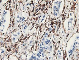 Latexin / MUM Antibody - IHC of paraffin-embedded Carcinoma of Human lung tissue using anti-LXN mouse monoclonal antibody.