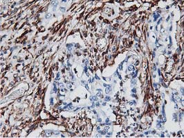 Latexin / MUM Antibody - IHC of paraffin-embedded Carcinoma of Human pancreas tissue using anti-LXN mouse monoclonal antibody.