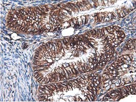 Latexin / MUM Antibody - IHC of paraffin-embedded Adenocarcinoma of Human endometrium tissue using anti-LXN mouse monoclonal antibody.