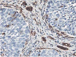 Latexin / MUM Antibody - IHC of paraffin-embedded Carcinoma of Human bladder tissue using anti-LXN mouse monoclonal antibody.