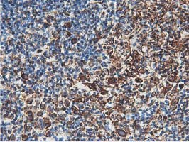 Latexin / MUM Antibody - IHC of paraffin-embedded Human lymphoma tissue using anti-LXN mouse monoclonal antibody.