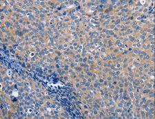 Latexin / MUM Antibody - Immunohistochemistry of paraffin-embedded Human cervical cancer using LXN Polyclonal Antibody at dilution of 1:25.