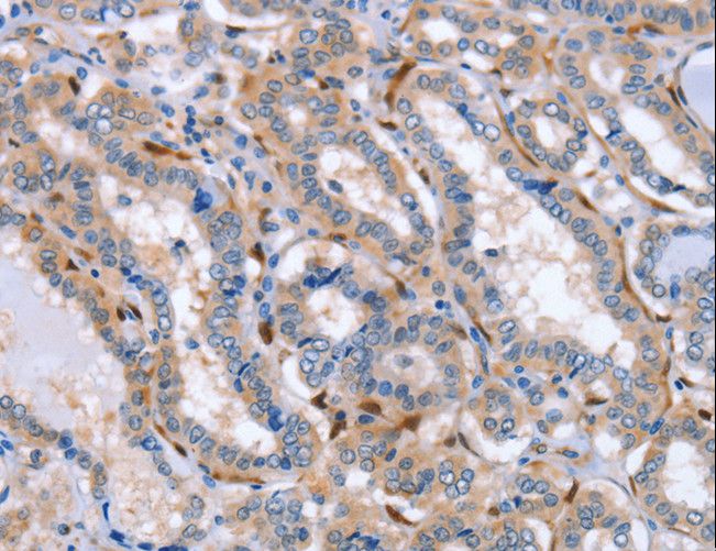 Latexin / MUM Antibody - Immunohistochemistry of paraffin-embedded Human thyroid cancer using LXN Polyclonal Antibody at dilution of 1:25.