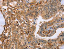 Latexin / MUM Antibody - Immunohistochemistry of paraffin-embedded Human thyroid cancer using LXN Polyclonal Antibody at dilution of 1:25.