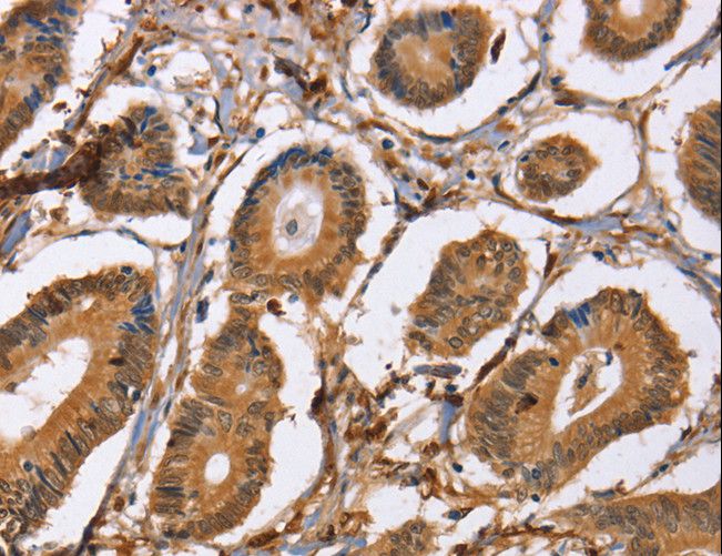 Latexin / MUM Antibody - Immunohistochemistry of paraffin-embedded Human colon cancer using LXN Polyclonal Antibody at dilution of 1:25.