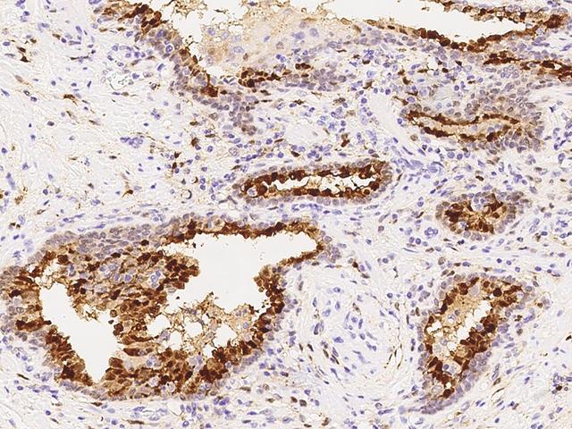 Latexin / MUM Antibody - Immunochemical staining of human LXN in human prostate with rabbit polyclonal antibody at 1:5000 dilution, formalin-fixed paraffin embedded sections.