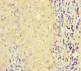 LATS1 Antibody - Immunohistochemistry of paraffin-embedded human liver cancer at dilution of 1:100