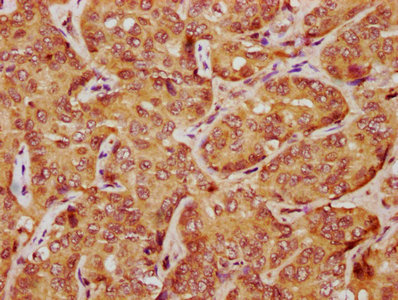 LATS1 Antibody - IHC image of LATS1 Antibody diluted at 1:1200 and staining in paraffin-embedded human liver cancer performed on a Leica BondTM system. After dewaxing and hydration, antigen retrieval was mediated by high pressure in a citrate buffer (pH 6.0). Section was blocked with 10% normal goat serum 30min at RT. Then primary antibody (1% BSA) was incubated at 4°C overnight. The primary is detected by a biotinylated secondary antibody and visualized using an HRP conjugated SP system.