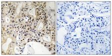 LATS1 + LATS2 Antibody - Immunohistochemistry analysis of paraffin-embedded human breast carcinoma tissue, using LATS1/2 Antibody. The picture on the right is blocked with the synthesized peptide.