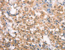 LATS2 Antibody - Immunohistochemistry of paraffin-embedded Human liver cancer using LATS2 Polyclonal Antibody at dilution of 1:30.