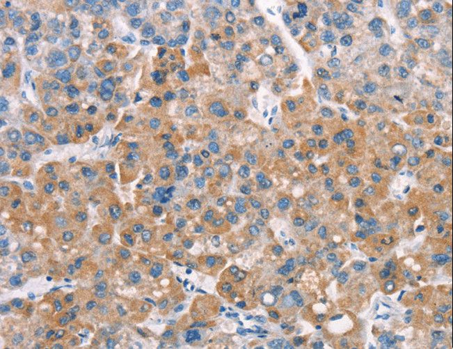 LATS2 Antibody - Immunohistochemistry of paraffin-embedded Human liver cancer using LATS2 Polyclonal Antibody at dilution of 1:30.
